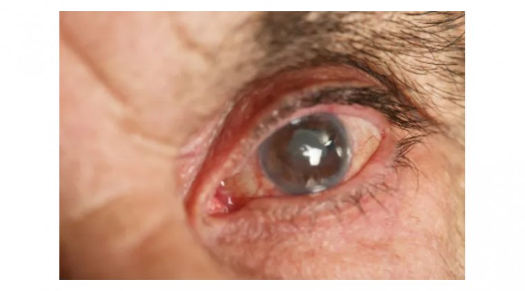 Cataracts: Causes, Symptoms, and Treatment Options