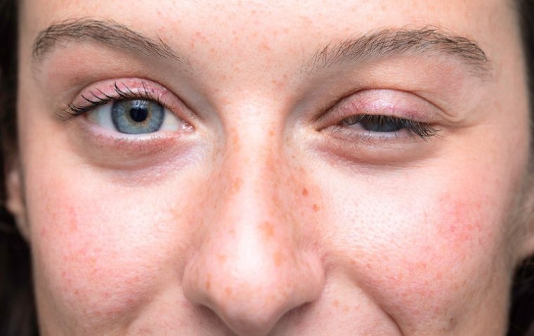 Ocular Myasthenia Gravis: Insights into Symptoms, Diagnosis, and Treatment