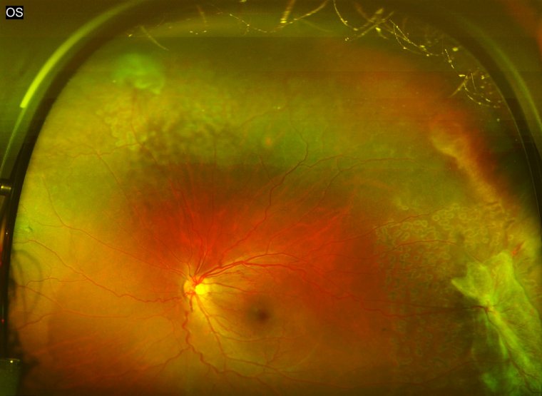 Sickle Cell Retinopathy: Understanding the Condition