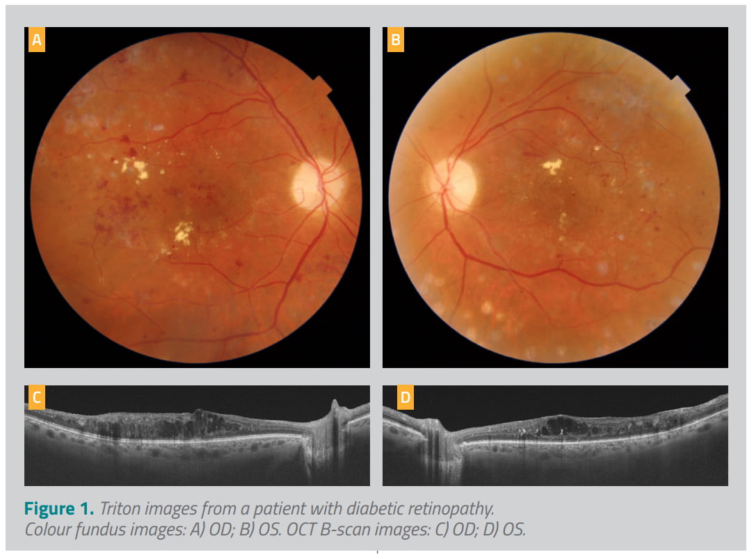 Triton images from a patient with diabetic retinopathy
