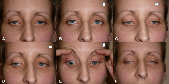 Symptoms of Chronic Progressive External Ophthalmoplegia