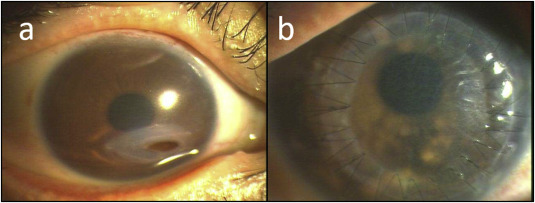 Three cases of acute sterile corneal melt after cataract surgery 