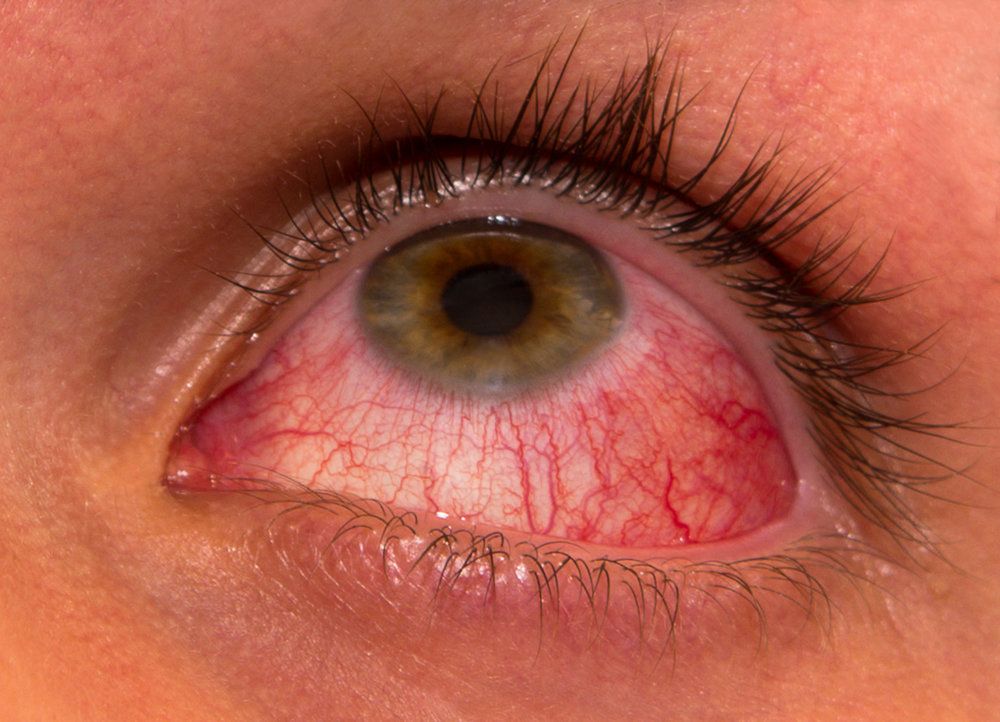 Conjunctivitis