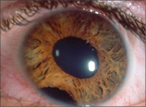 close-up picture of an eye with iridodialysis