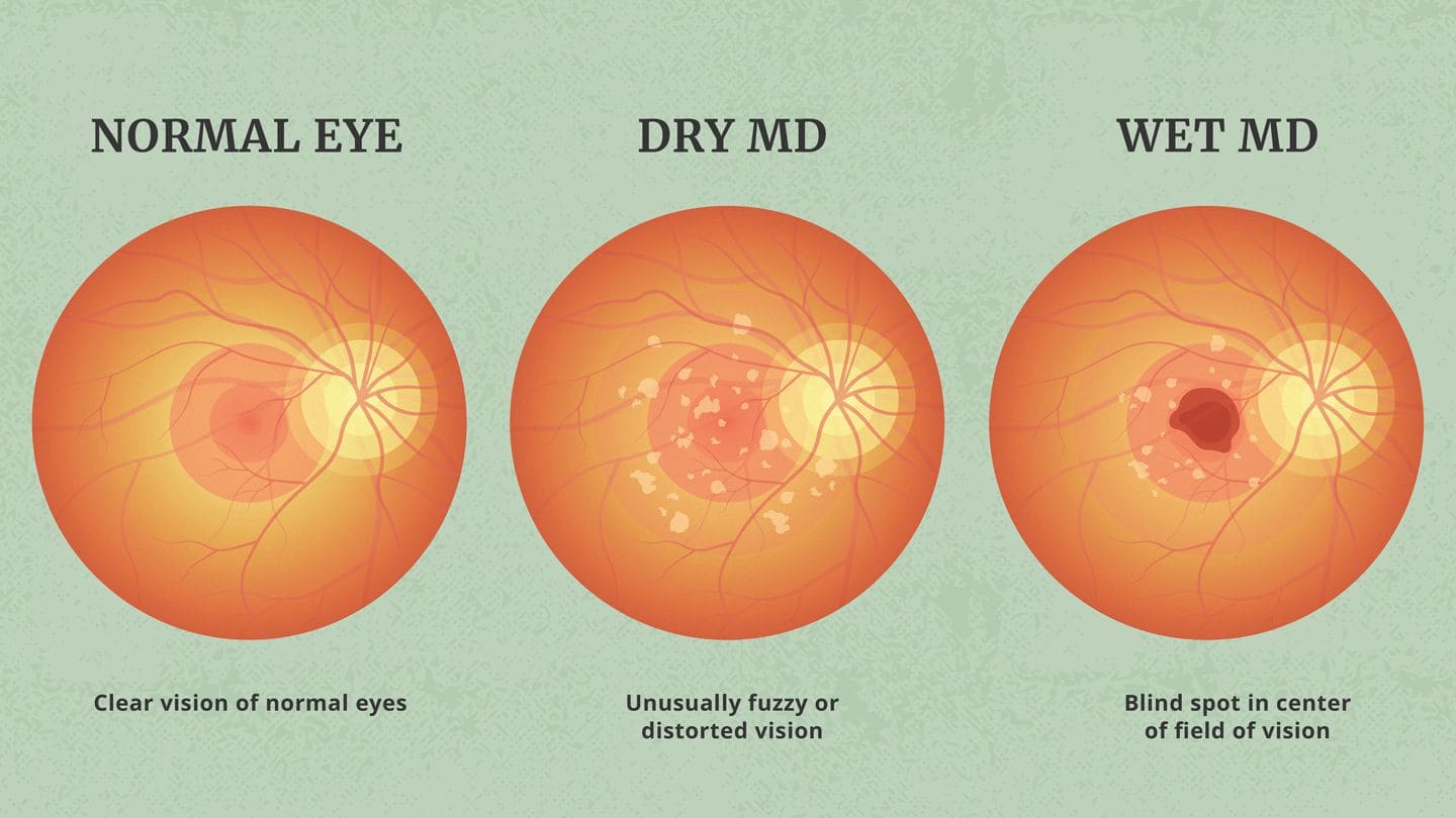 a visual showing the normal eye, dry md and wet md