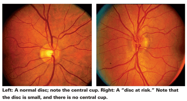 Ischemic Optic Neuropathy 