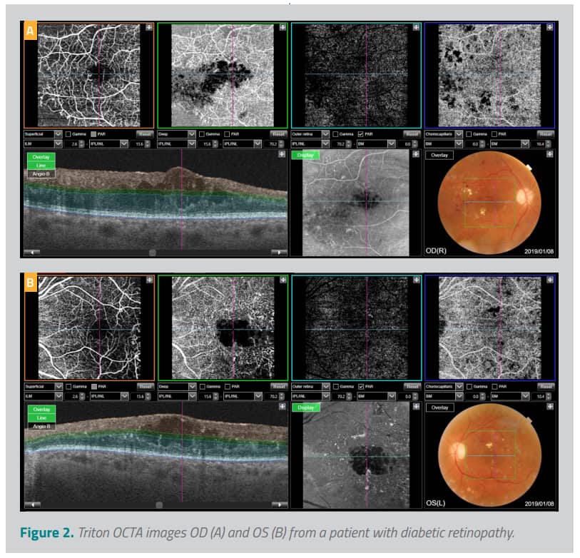 Triton OCTA images OD(A) and OS(B) from a patient with diabetic retinopathy