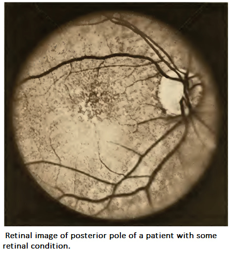Retinal image of posterior pole of a patient with some retinal condition