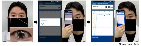 A researcher is measuring his blood glucose after wearing the smart contact lenses. (credit: Severance Hospital) 