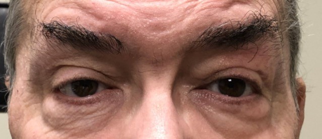 Myasthenia Gravis Ptosis