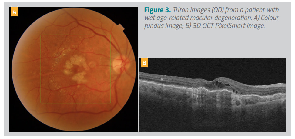 Triton images (OD) from a patient with wet age-related macular degeneration
