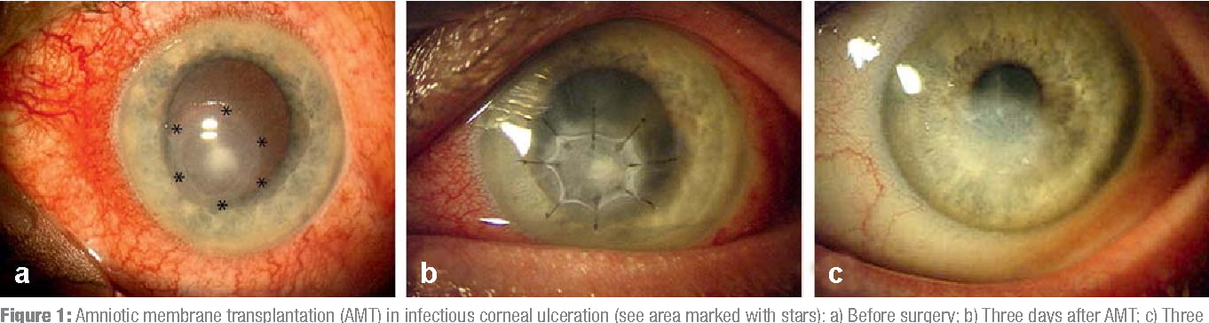 amniotic membrane transplantation in infectious corneal ulceration
