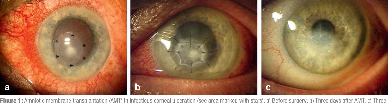 What Is Amniotic Membrane Transplantation Obn