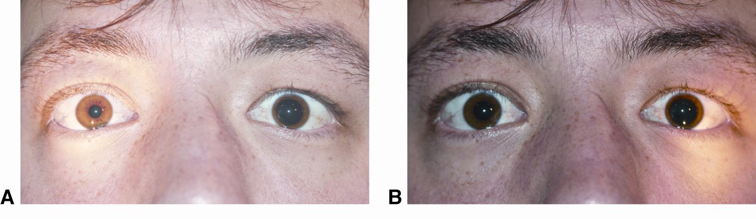 Relative Afferent Pupillary Defect