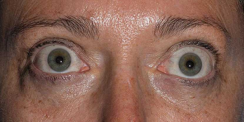 closeup picture of eyes with graves eye disease 