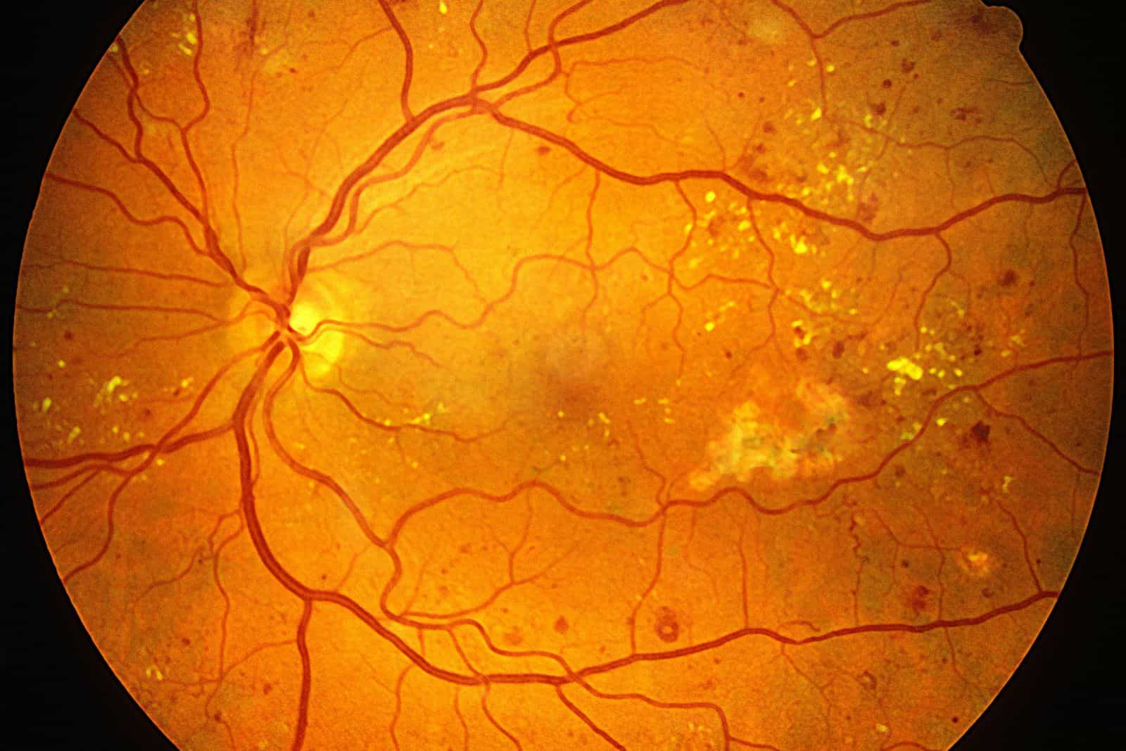 Early AntiVEGF Treatment of Diabetic Retinopathy