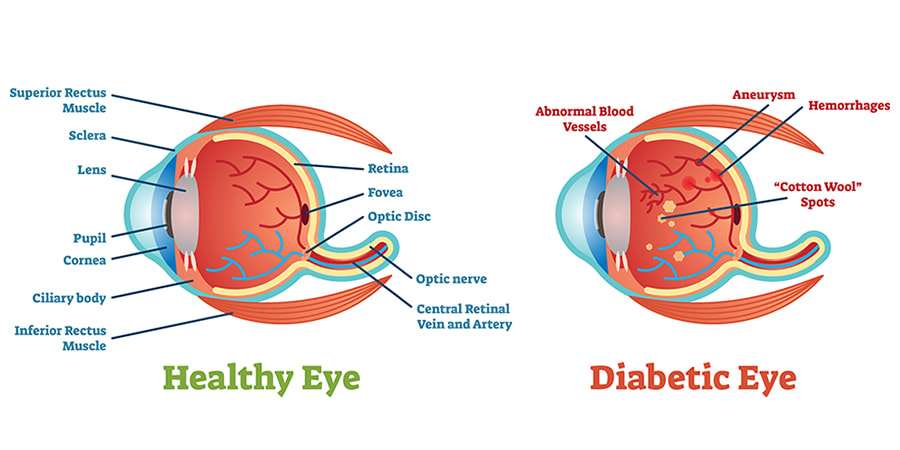 an image showing the differences between healthy eye and diabetic eye