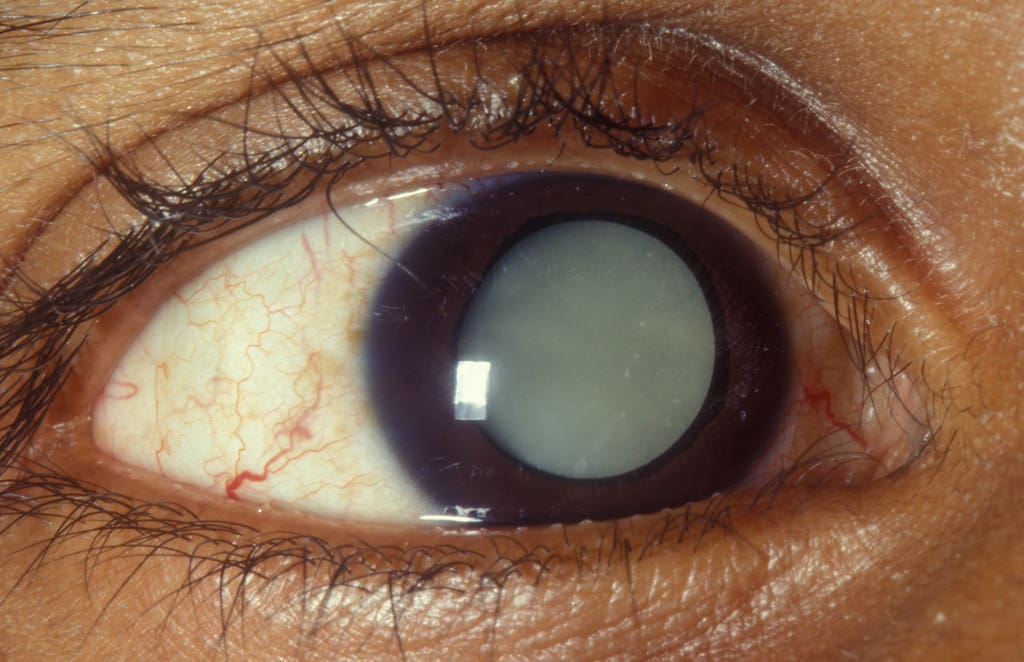 Dense cataracts