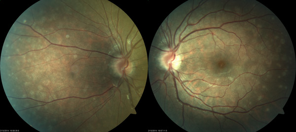 Colour fundus photographs of the left eye showing a hyperaemic, swollen optic disc and multiple white dots of the posterior pole.