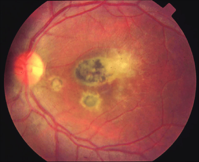 eye with Chorioretinitis