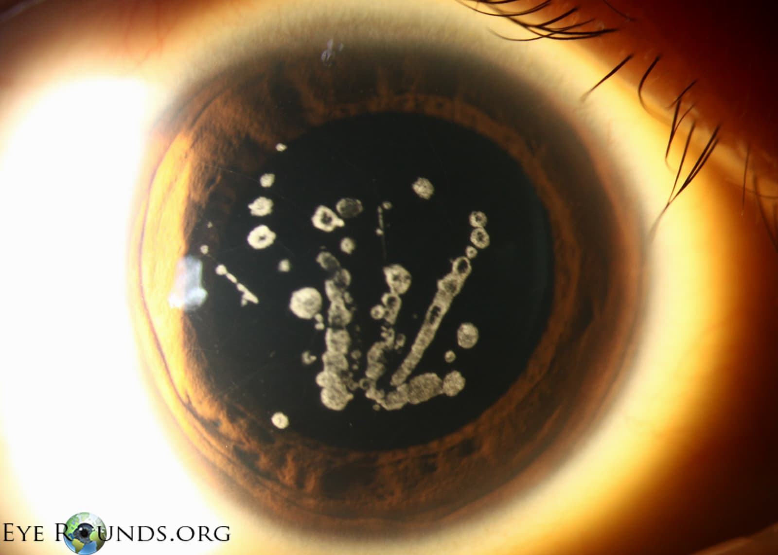 Granular corneal dystrophy