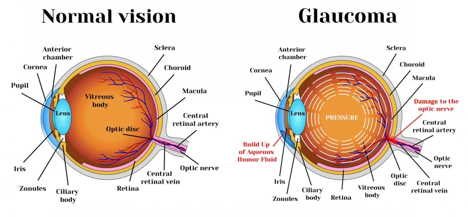 a visual showing the differences between normal vision and glaucoma