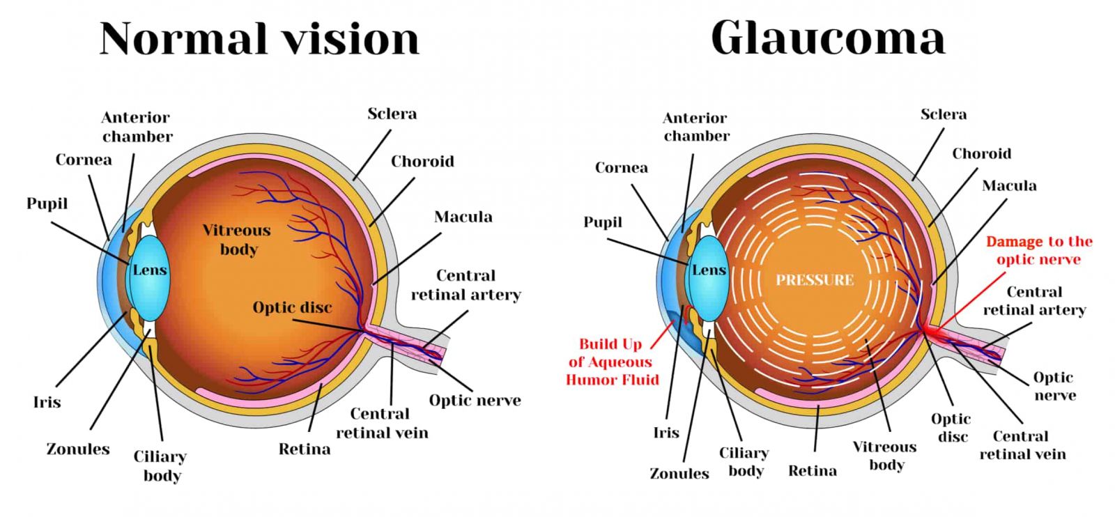 new-guidelines-by-the-european-glaucoma-society-i-obn