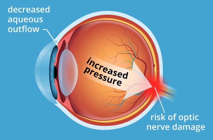Ocular hypertension