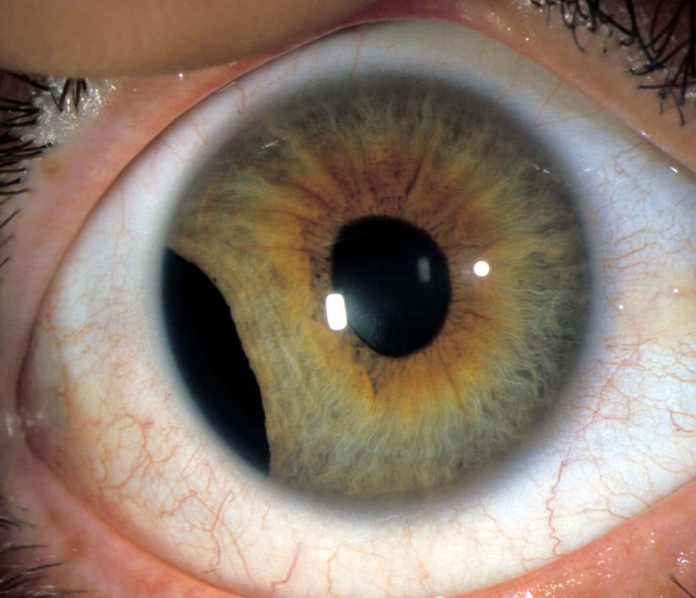 eye with iris trauma