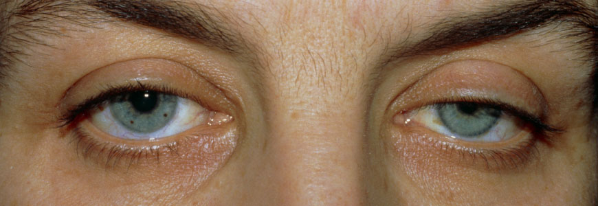 close up of a man's eyes with ptosis