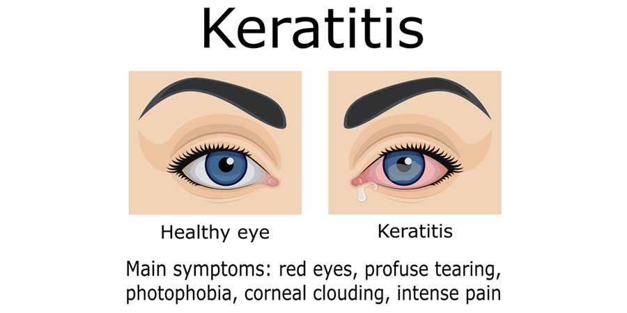 Keratitis