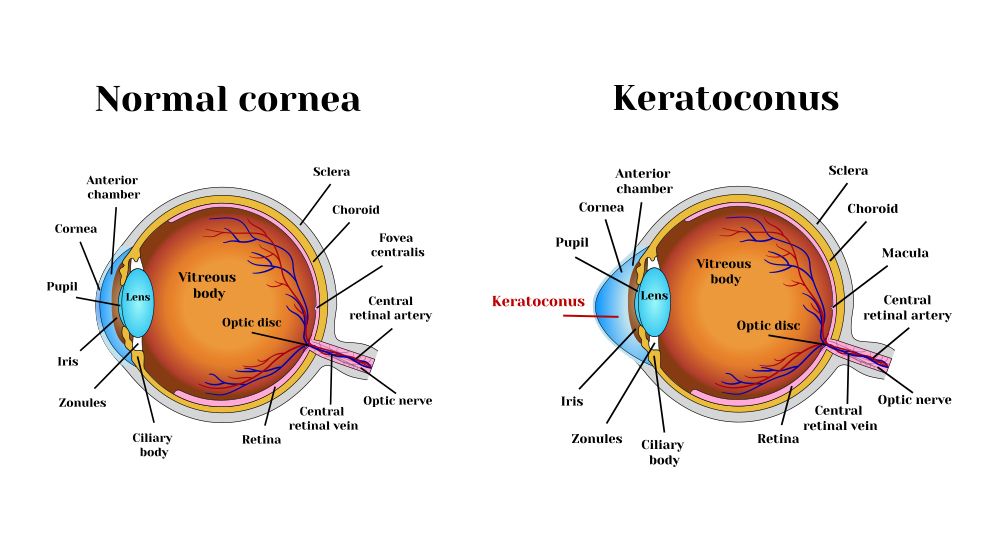 Normal cornea vs keratoconus