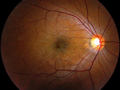 Macular Edema Credit: Retina Care Consultants 