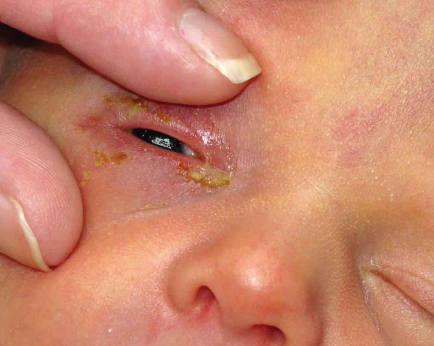 a baby's eye with Ophthalmia Neonatorum