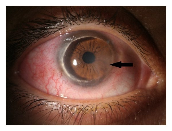 Conjunctival Injection 