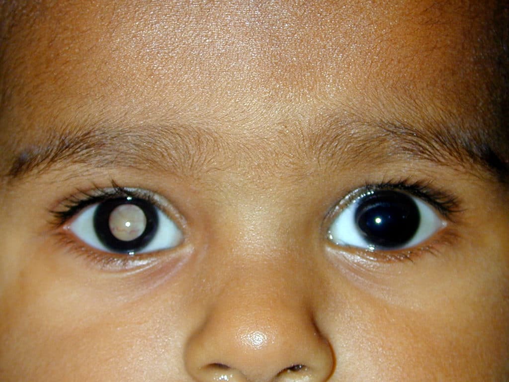 a picture of a baby with Retinoblastoma