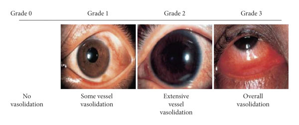 Grades of Conjunctival Hyperemia