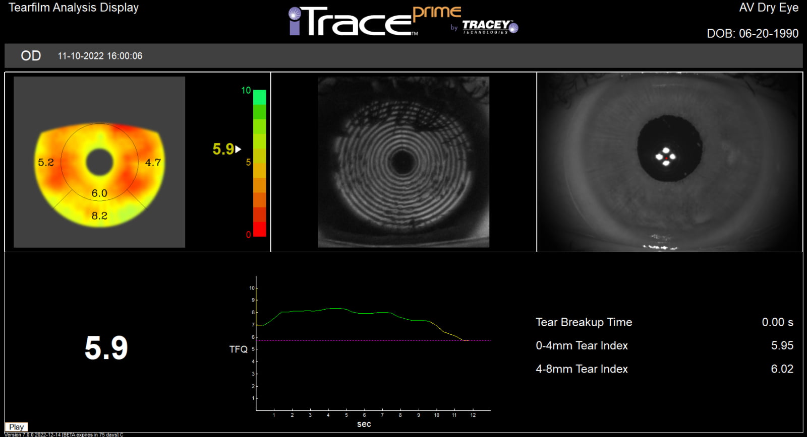 tearfilm analysis display