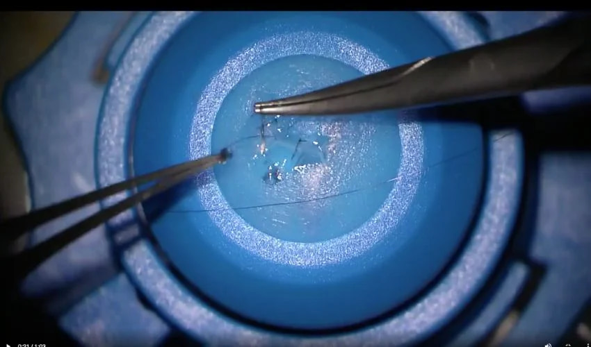 3D bioprinting for surgical precision