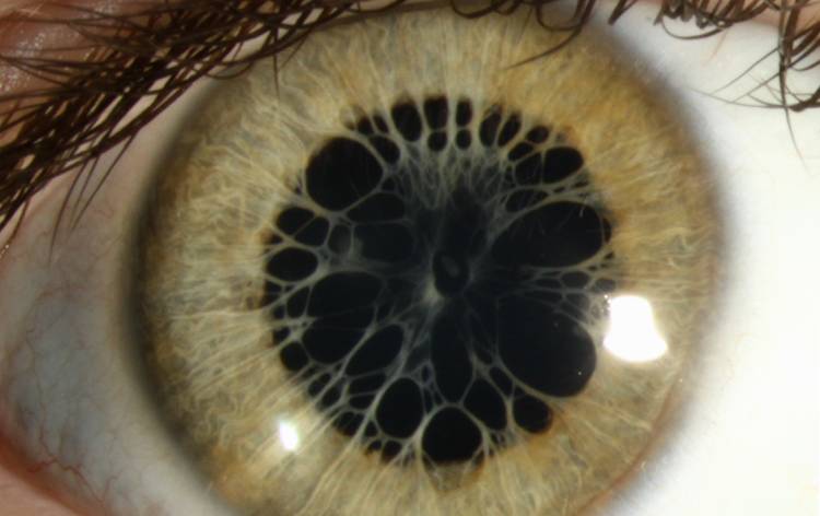 Persistent Pupillary Membrane