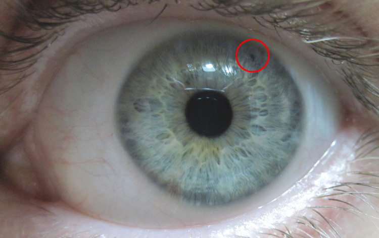 close-up picture of an eye with eye condition