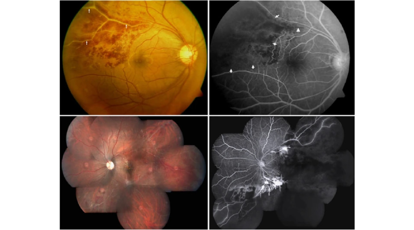 The three hallmark signs of the Eales’ disease are retinal phlebitis, peripheral nonperfusion, and retinal neovascularization.
