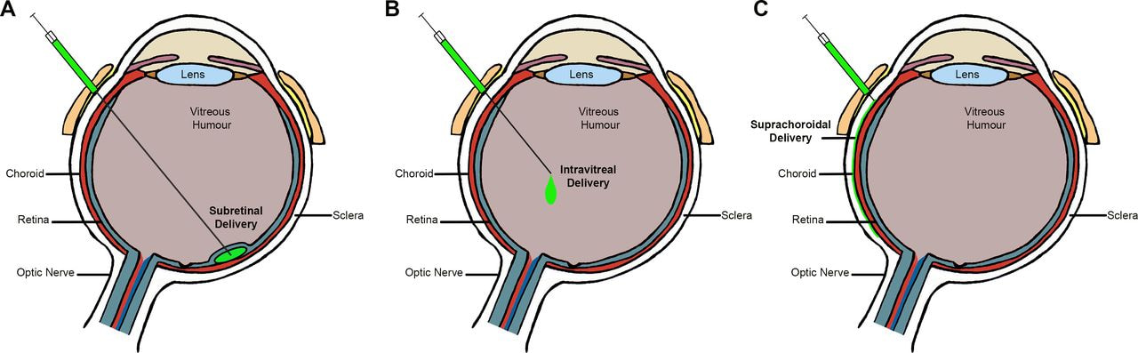 an illustration giving information on Gene therapy for neovascular age-related macular degeneration