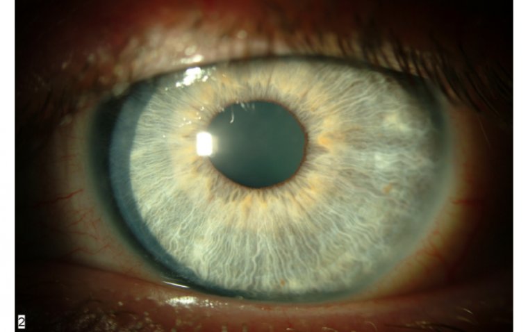 A Rare Disease that Attacks the Cornea: Thygeson's Superficial Punctate Keratitis