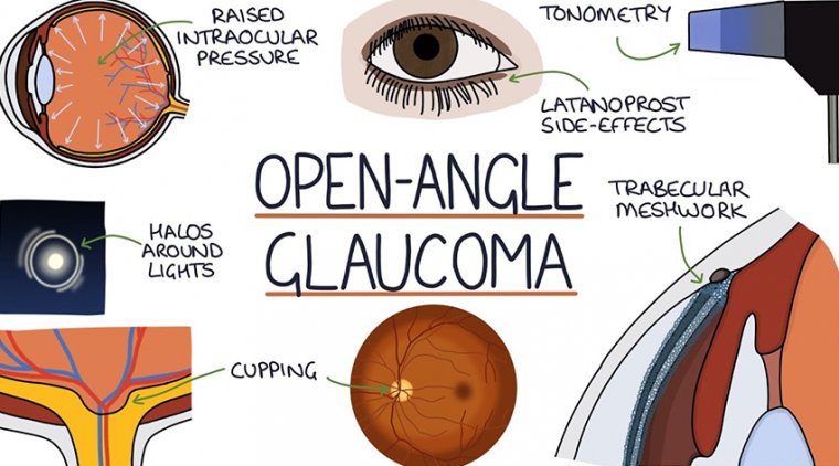 Advancements in Treatment of Open-Angle Glaucoma