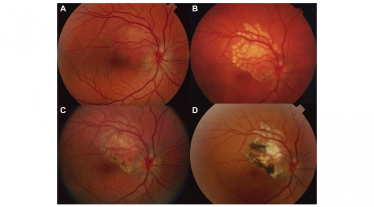 All About Choroidal Hemangioma: What You Need to Know