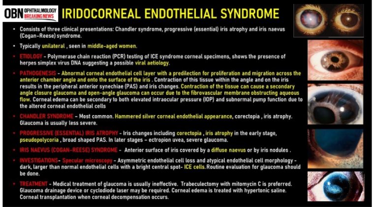 All About Irido-Corneal Endothelial Syndrome
