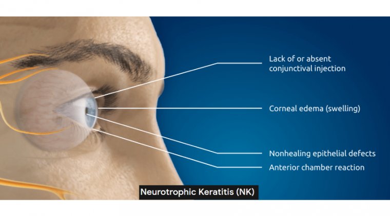 All About Neurotrophic Keratitis 