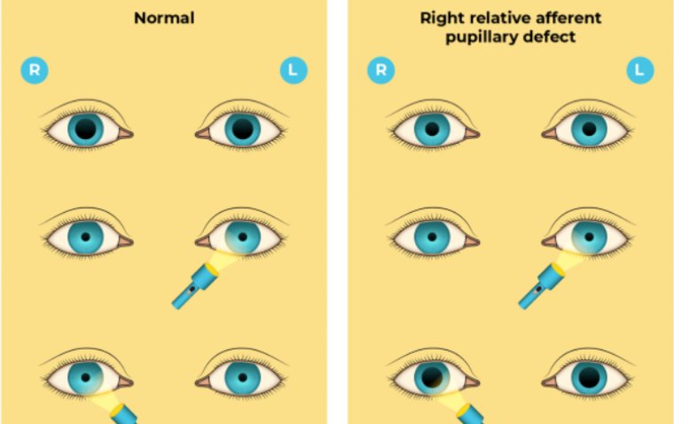 An Asymmetrical Gaze: A Closer Look at Relative Afferent Pupillary Defect