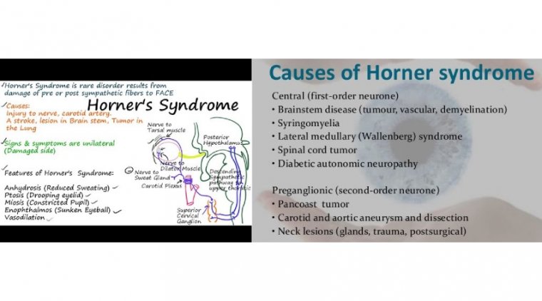 An Overview of Horner Syndrome